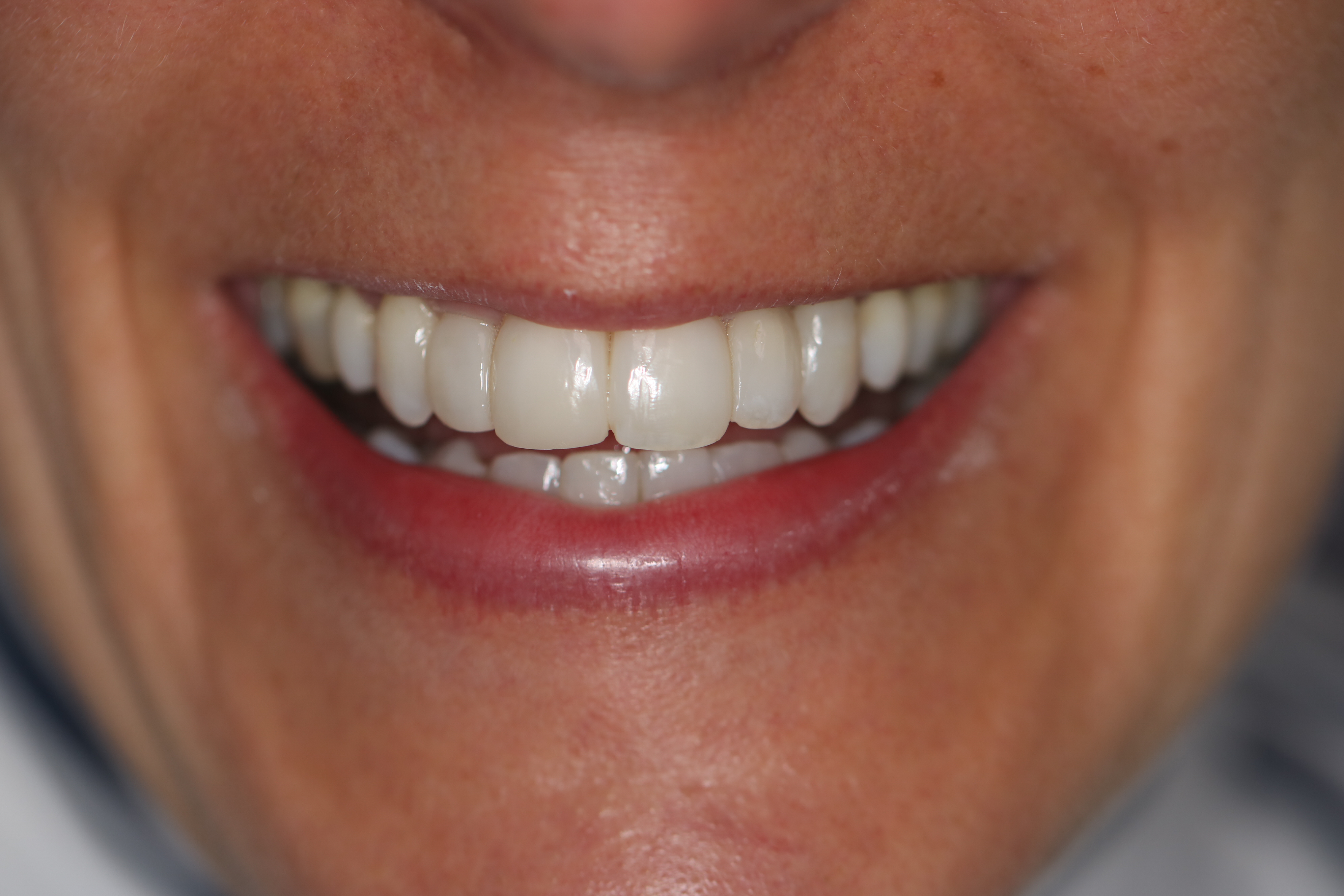 Black Triangles Between Teeth and Old Discoloured Fillings - Esthetique